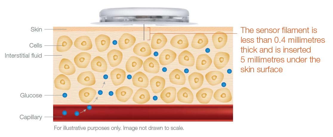 How Does Freestyle Libre Work For Diabetes DiabetesWalls